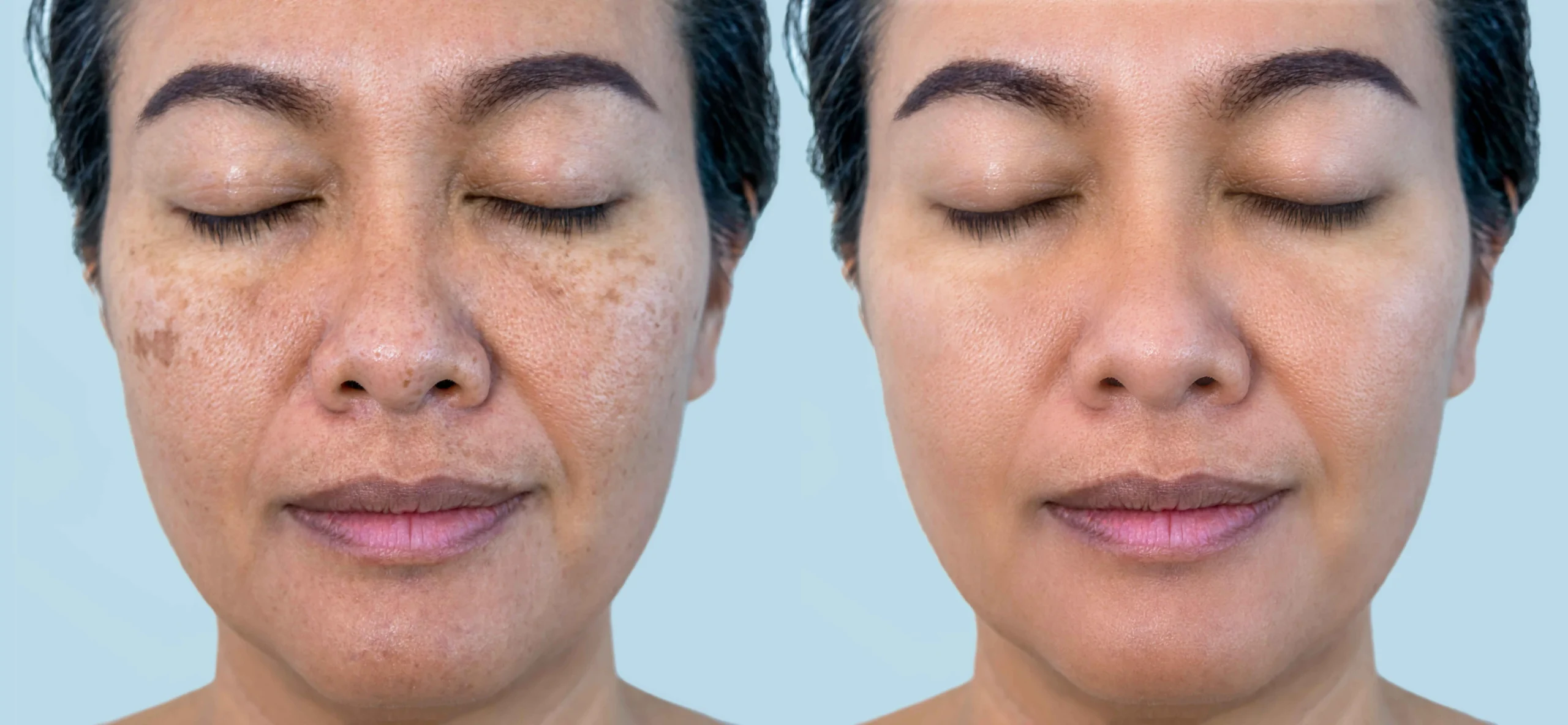 K-Pico for Hyperpigmentation